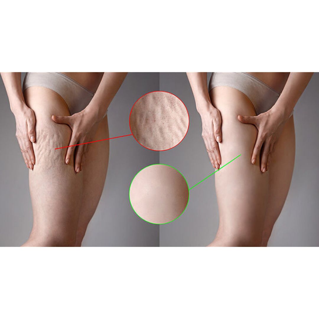 Cellulite Treatment