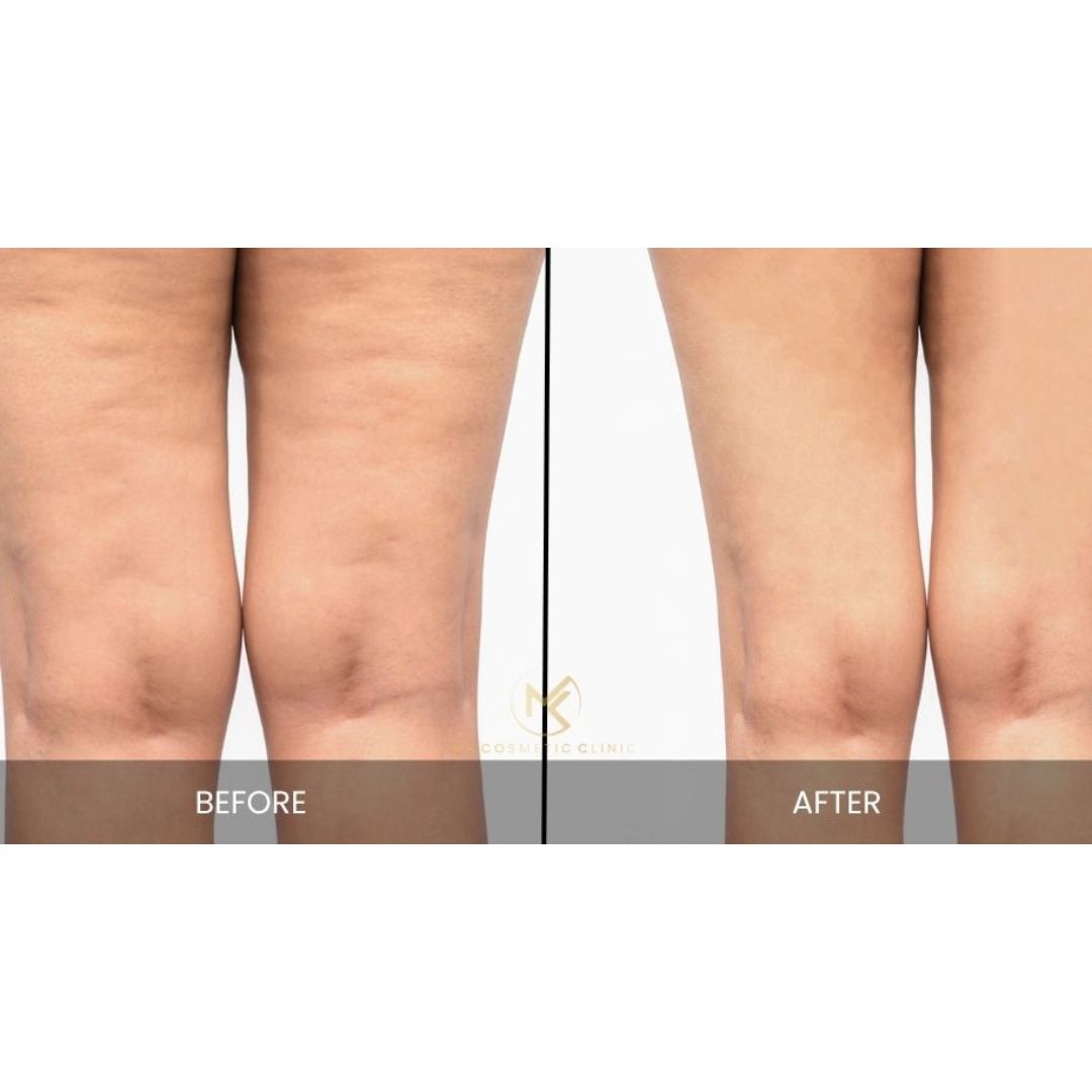 Cellulite Treatment