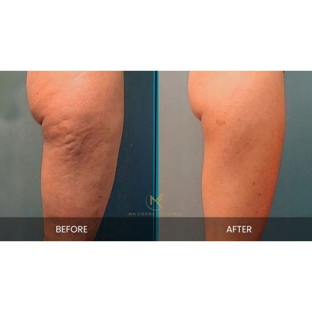 Cellulite Treatment