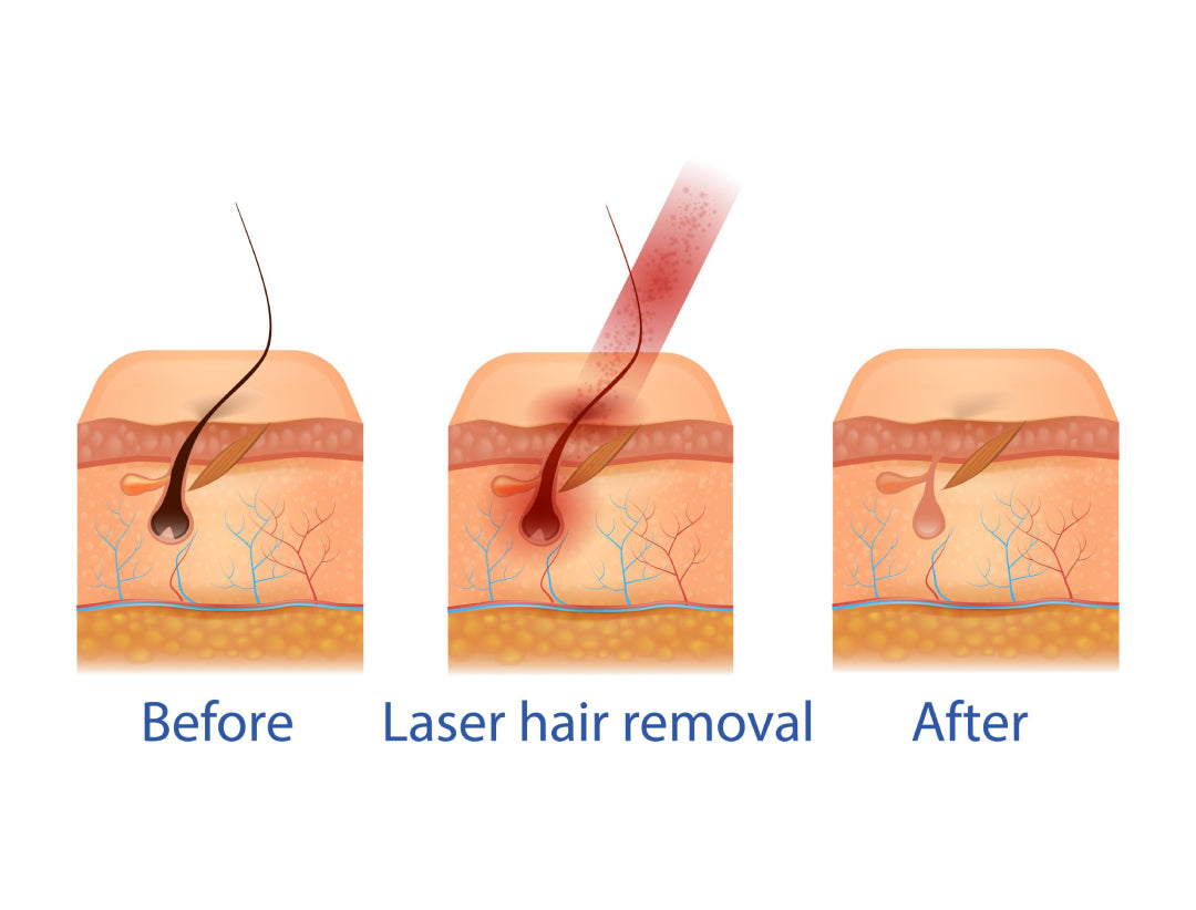 laser hair removal near me, laser hair removal bikini area
