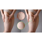 Cellulite Treatment