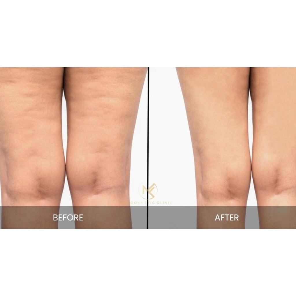 Cellulite Treatment