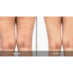Cellulite Treatment