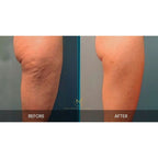 Cellulite Treatment